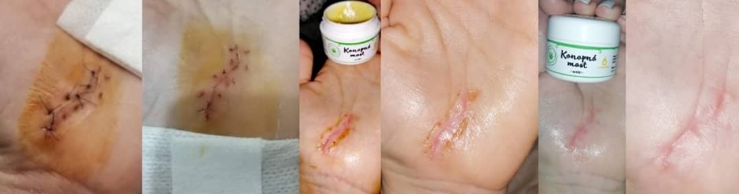 Scar Healing With Hemp Ointment With Marigold